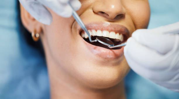 Best Emergency Dentist for Lost Fillings or Crowns in USA